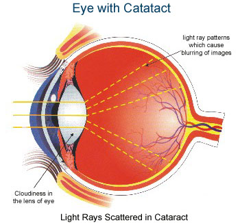 cataract-1