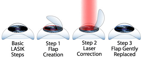 Why go For Lasik and if not, what are the available options
