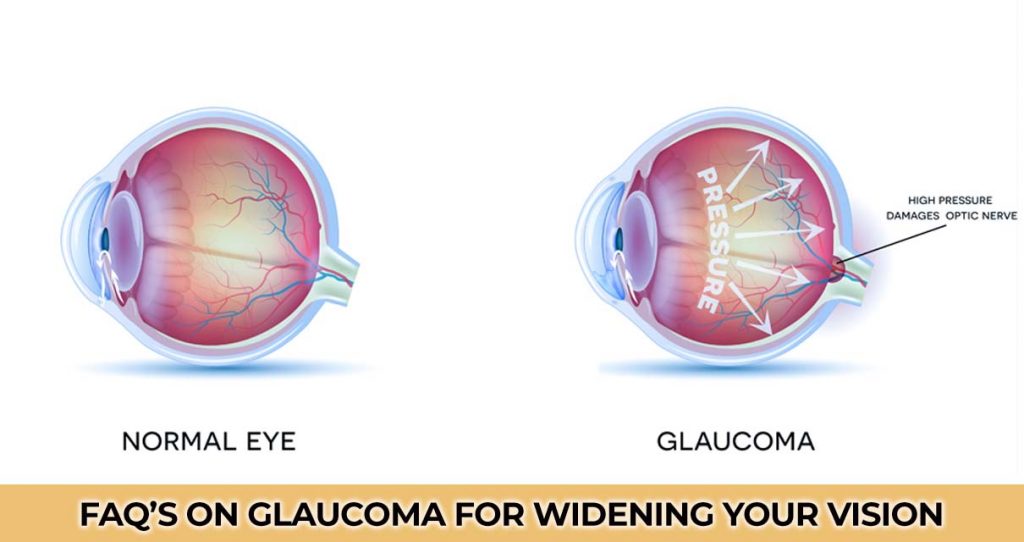 FAQ’s on Glaucoma for widening your vision