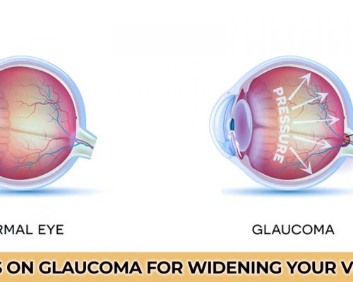 FAQ’s on Glaucoma for widening your vision