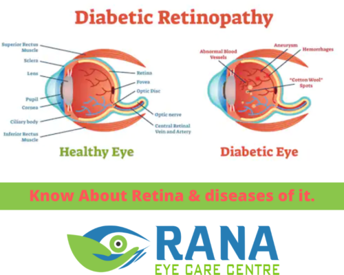 Know About Retina & diseases of it.