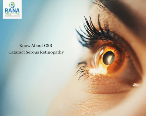 Know About CSR – Cataract Serous Retinopathy