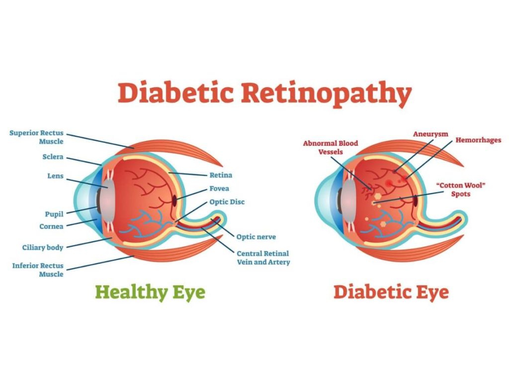 what-is-diabetic-retinopathy
